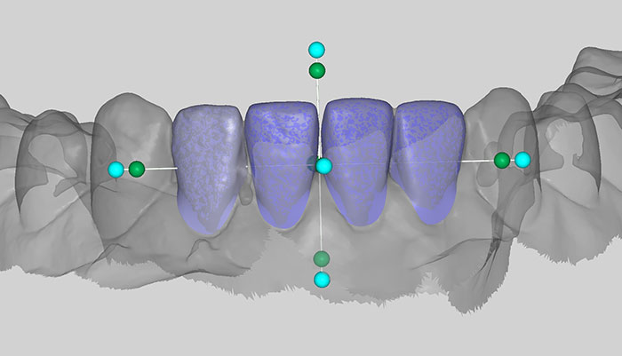 Provisional Crown / Bridge(Shell Tec.)