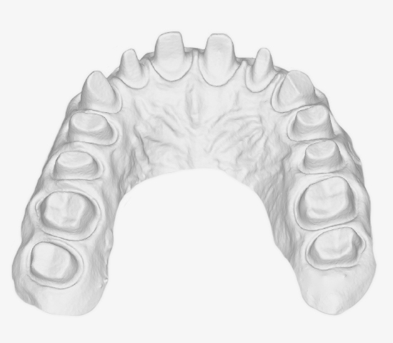 Full arch tray