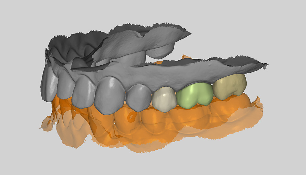 Outil de CAO RAYDENTConception de dents sur mesure grâce à l'IA